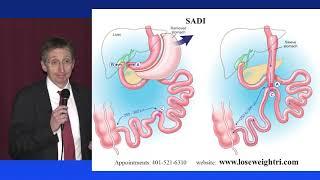 12. RWMC - Bypass Sleeve SADI or DS Which is right for me?