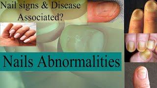 Nail Abnormalities  Nail signs & Diseases  Medicine