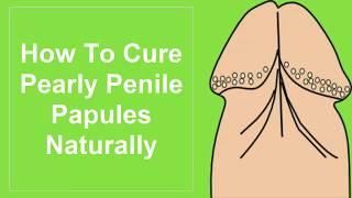 How To Cure Pearly Penile Papules Naturally  How To  Get Rid of Pearly Penile Papules At Home