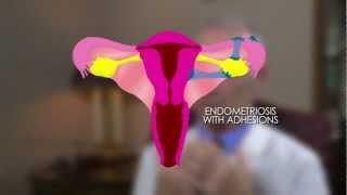 Uterine Adhesions and Endometriosis with Gynecologist Dr. John Dulemba