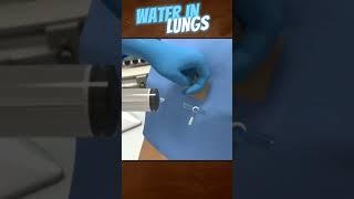Water in Lungs Treatment  Pleural Fluid Aspiration in 3D