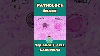 Squamous cell carcinoma  Pathology image #shorts