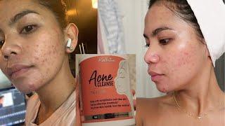 Kallistia Acne Cleanse Skin Care for 30 Days Honest Review  Hormonal Acne  My Skin Journey