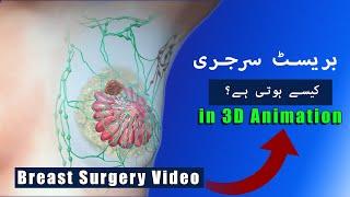 Breast Cancer Surgery In 3D Animation