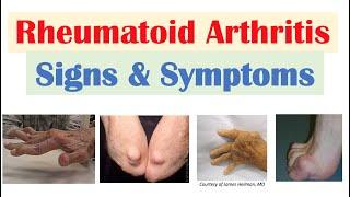 Rheumatoid Arthritis RA Signs & Symptoms & Associated Complications