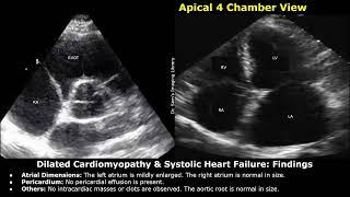 Dilated Cardiomyopathy & Systolic Heart Failure Echocardiography Report Example  Cardiac Diseases