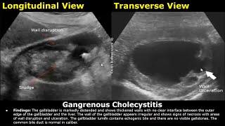 Abdominal Ultrasound Reporting  Liver Gallbladder Bile Duct Pancreas Spleen Kidney USG Reports