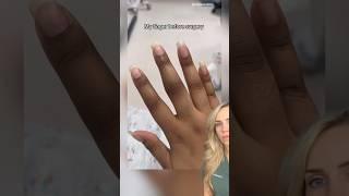 Doctor reacts finger amputation?