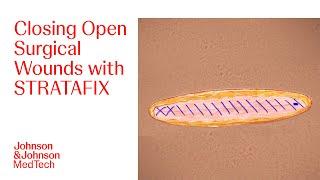 Suturing Techniques for Optimal Wound Closure with STRATAFIX in Open Surgery  J&J MedTech