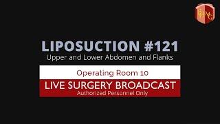 How It’s Done –  Lipo  of Upper & Lower Abdomen and  Flanks Male 38 General Anesthesia #lipo