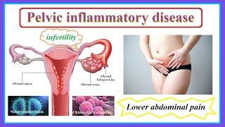 pelvic inflammatory disease