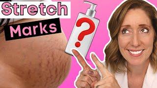 How to Fade Stretch Marks  Proven Tips for Stretch Mark Treatments