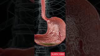 How To Prevent Stomach Ulcers and How To Treat Them