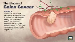 Stages of Colon Cancer