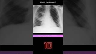 Chest X-ray Question 9 with explanation