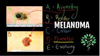 Melanoma - Symptoms signs diagnosis and management