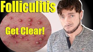 Folliculitis Skin Bumps  Get Clear Skin and Scalp  Causes and Cures