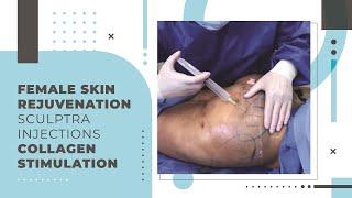 Female Skin Rejuvenation  Sculptra Injections  Collagen Stimulation