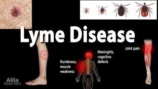 Lyme Disease Animation
