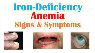 Iron-Deficiency Anemia Signs & Symptoms ex. Fatigue “Spoon Nails” Cracked Lips