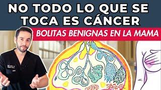 NO TODO ES CÁNCER - Hablemos de las BOLITAS BENIGNAS más comunes