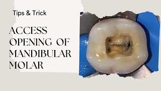 Access Opening of Mandibular Molar