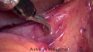 Laparoscopic repair of Small bowel obstruction