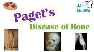 Paget’s Disease of Bone Osteitis Deformans  Causes Pathogenesis Symptoms Diagnosis & Treatment