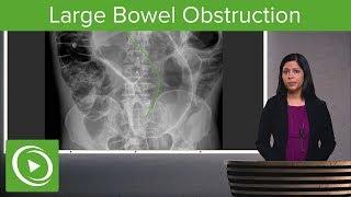 Bowel Obstruction and Ileus Large Bowel Obstruction & Ogilvie Syndrome – Radiology  Lecturio