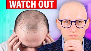 Biggest Hair Transplant SCAM? DHI vs FUE