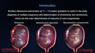 UOG video abstract Outcome of twin pregnancy with two live fetuses at 11–13 weeks’ gestation