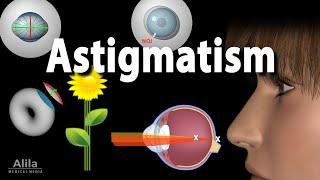 Astigmatism Types Causes Symptoms and Treatment Options Animation