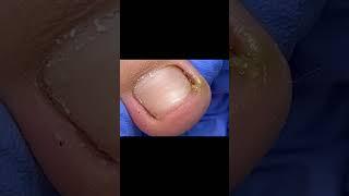 Trim ingrown toenails easily and perfectly #satisfying