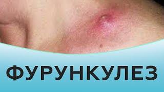 Фурункулез  Фурункулы как лечить  Причины фурункулеза