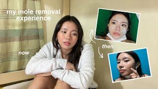 MY MOLE REMOVAL EXPERIENCE how much was it painful expectations  Philippines