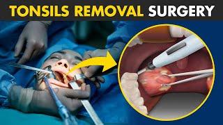 How Tonsillectomy Procedure Is Performed?  Tonsils Removal Surgery Tonsillectomy