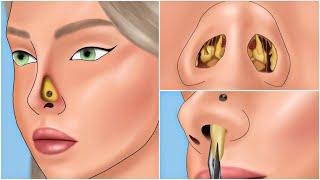 ASMR Nose Mucus Deep Cleaning Animation  Massive Booger and Unmanaged Piercing Removal