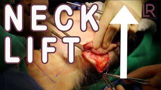 Neck Lift Surgery to Treat Loose Skin on the Lower Face and Neck