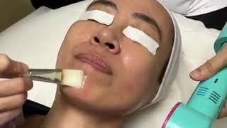 Vitamin C Brightening Peel By Enhanze Clinic