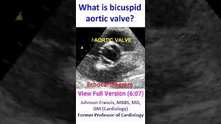 What is bicuspid aortic valve?