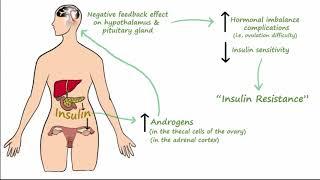 Polycystic Ovarian Syndrome PCOS - Pathophysiology Symptoms Treatment