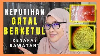 KEPUTIHAN BERKETUL SEPERTI KRIM & KEPUTIHAN GATAL Kenapa? Cara Merawat & Hilangkan Keputihan Gatal?