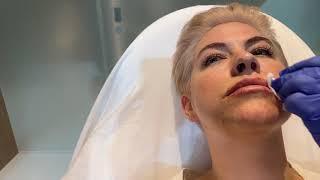 RESTYLANE KYSSE RUSSIAN LIP KEYHOLE POUT FOR GIRLS WHO WANT PLUMP SOFT LIP SHAPE  DR. JASON EMER