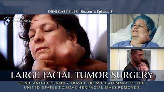 Large Facial Parotid Tumor Removal - A Life Changed Forever