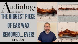 THE BIGGEST PIECE OF EAR WAX REMOVED...EVER - EP609