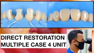 Direct Restoration Multiple Case  2x SPEED  Tambal Gigi  Dokter Gigi Griya RR