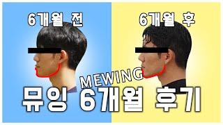 MEWING 도전 혓바닥 운동 뮤잉 6개월 해봤습니다. 얼마나 바뀌었을까요?