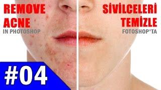 Photoshop Sivilce Yüz Temizleme - Photoshop Acne Face Cleansing