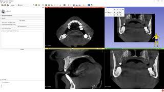 3D Slicer.Просмотр КТ. Стоматология