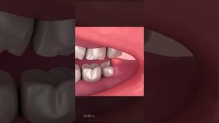 Wisdom Teeth Impaction Explained